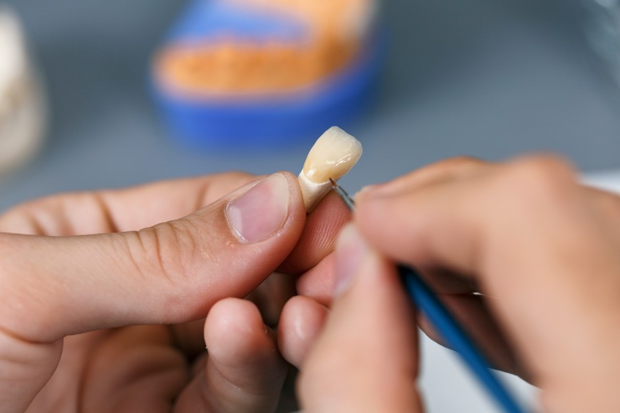 Ceramic Crowns & Bridges Fixing